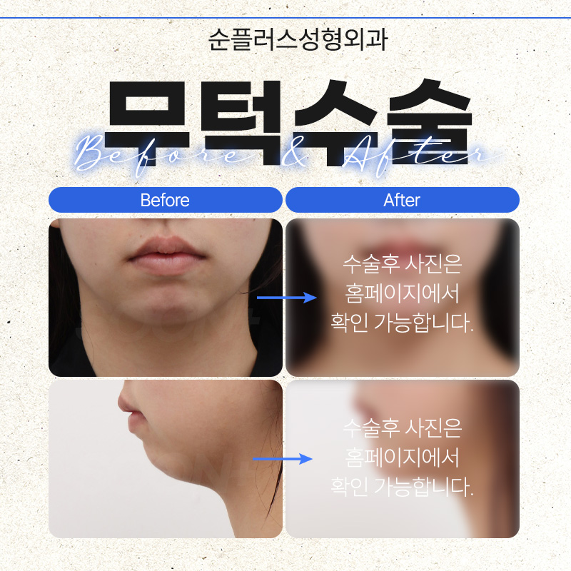 무턱성형ㅣ작은턱 교정으로 균형있는 비율 관련 이미지 5