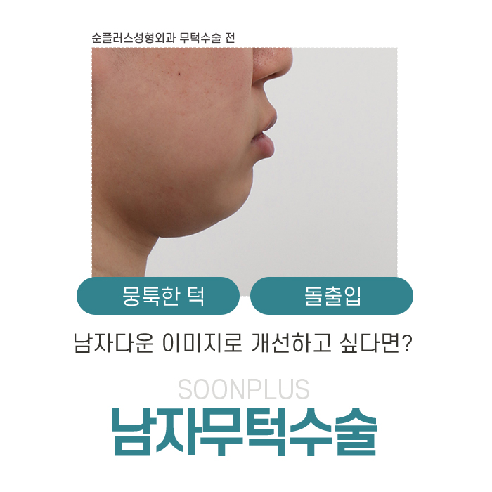 Male Receding Chin Surgery: When Chin Tip Volume Changes image 1