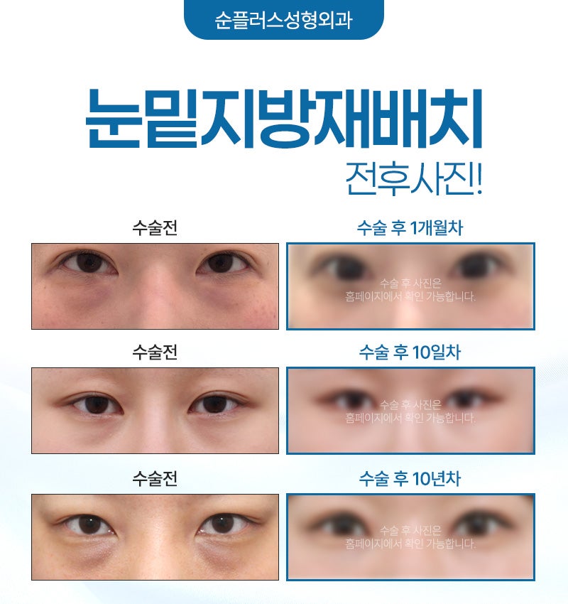 눈밑지방재배치수술 회복은 빠르게 재발은 없도록 관련 이미지 6
