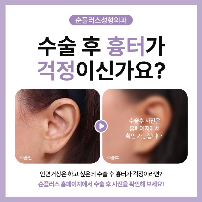 안면거상잘하는병원 처진피부가 고민될때는 관련 이미지 5