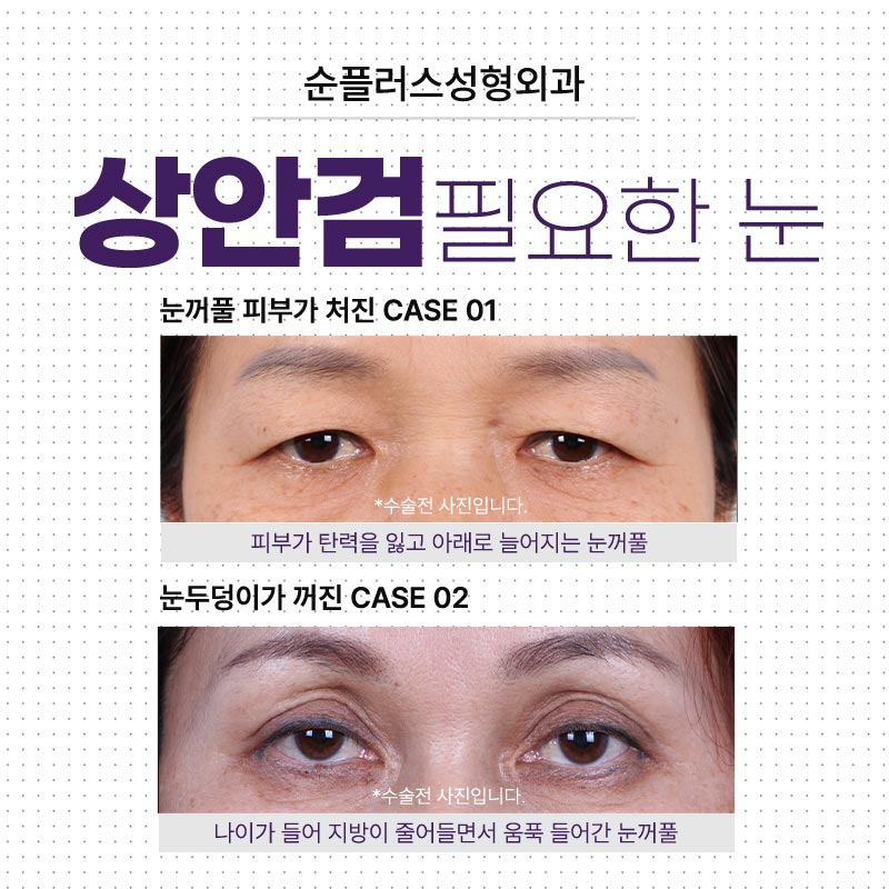 중년쌍꺼풀수술 처짐은 자연스럽게 관련 이미지 5