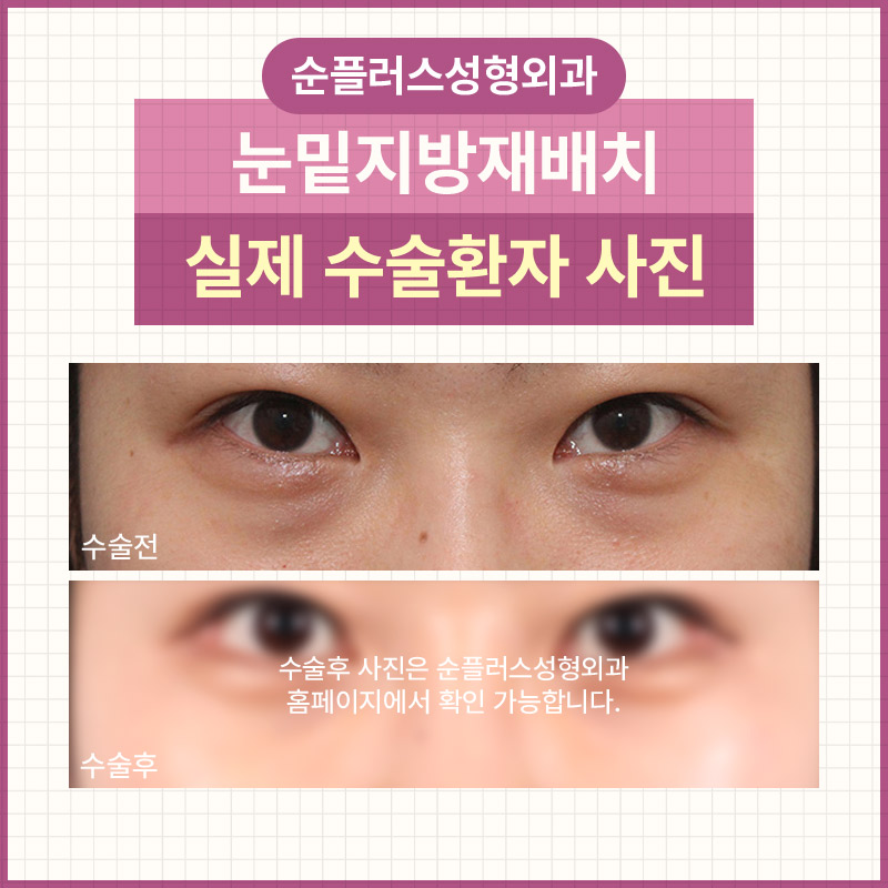 눈밑지방수술 꺼짐과 돌출이 동반되었을때 관련 이미지 5