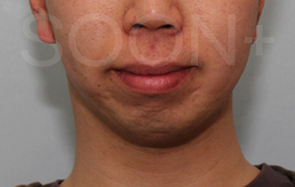 경계가 불분명한 턱끝, 무턱수술 플랜이 필요할때 관련 이미지 1