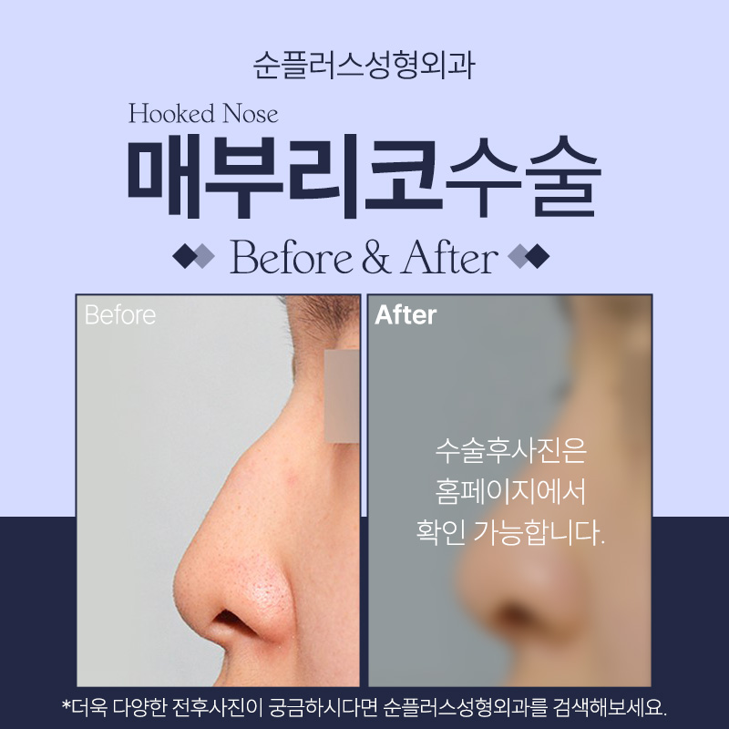 매부리코성형 굴곡짐을 개선해 관련 이미지 5