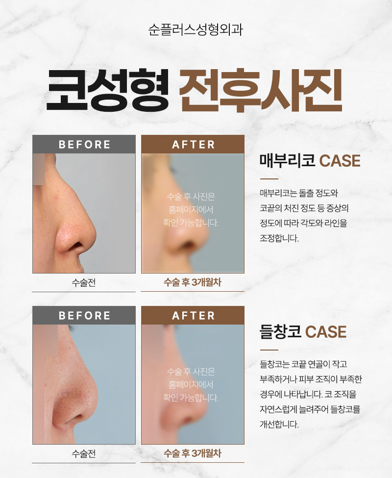 코수술 비용보다 중요한건 조화로운 결과 관련 이미지 3