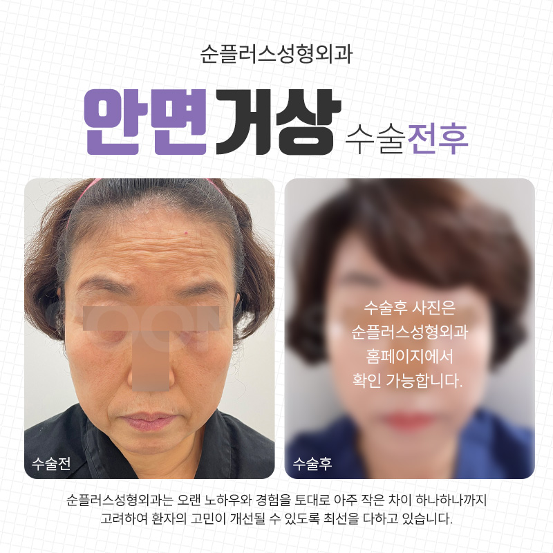 The Best Place for Facelift Surgery When Skin Elasticity Changes image 5
