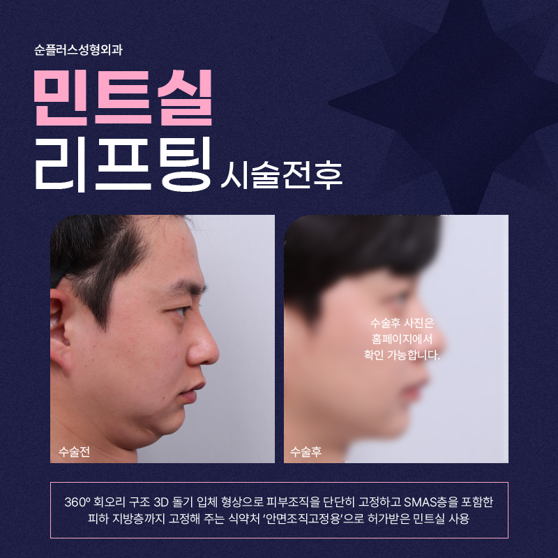 남자실리프팅 자연스러운 라인정리로 자신감 높이고 관련 이미지 5