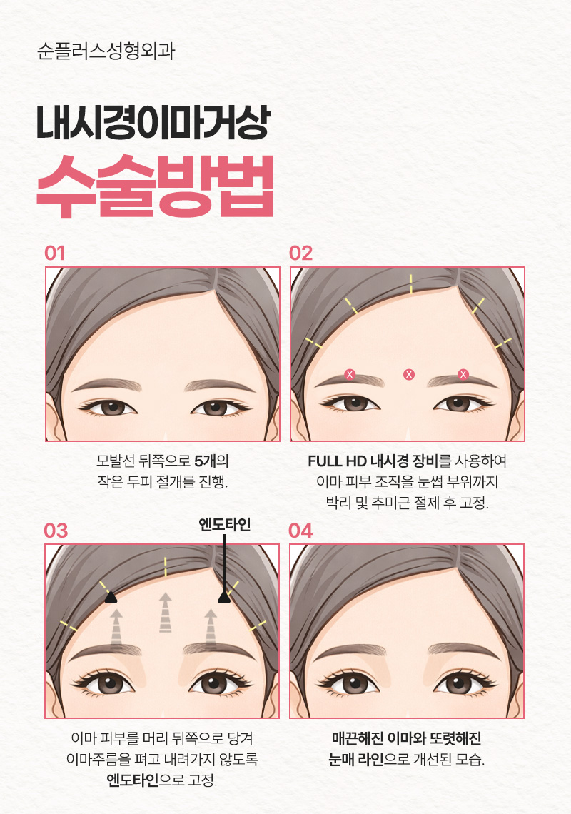 If Endoscopic Forehead Lift Precautions Are Followed Well image 3