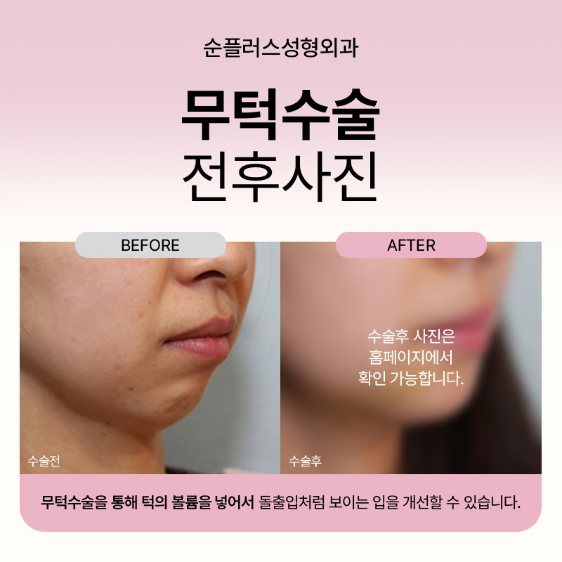 무턱수술ㅣ어떤 보형물이 적합할지 고민될때 관련 이미지 5