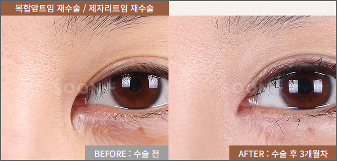 몽고주름으로 답답한 눈매, 부자연스러운 쌍꺼풀라인 개선 위한다면 올바른 앞트임 방법으로 관련 이미지 6