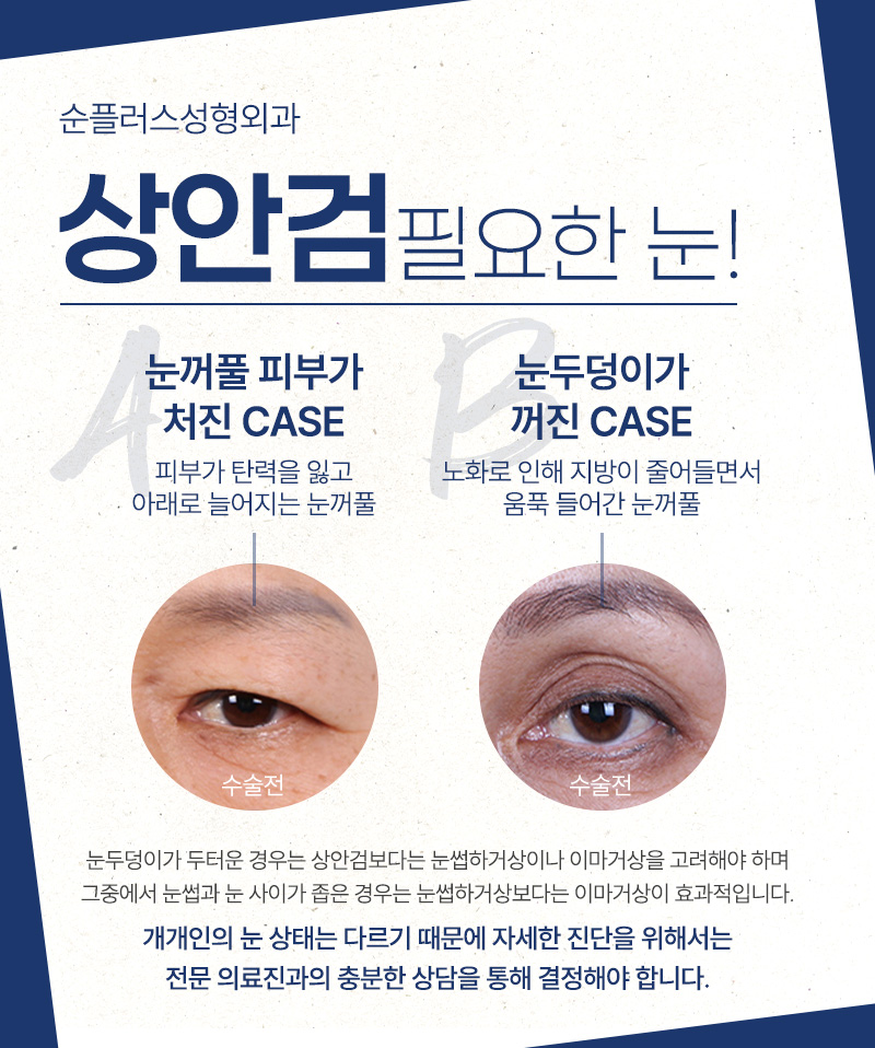 노화로 처진 눈꺼풀, 중년눈성형에 적합한 수술방법을 적용해야 [상안검수술] 관련 이미지 4