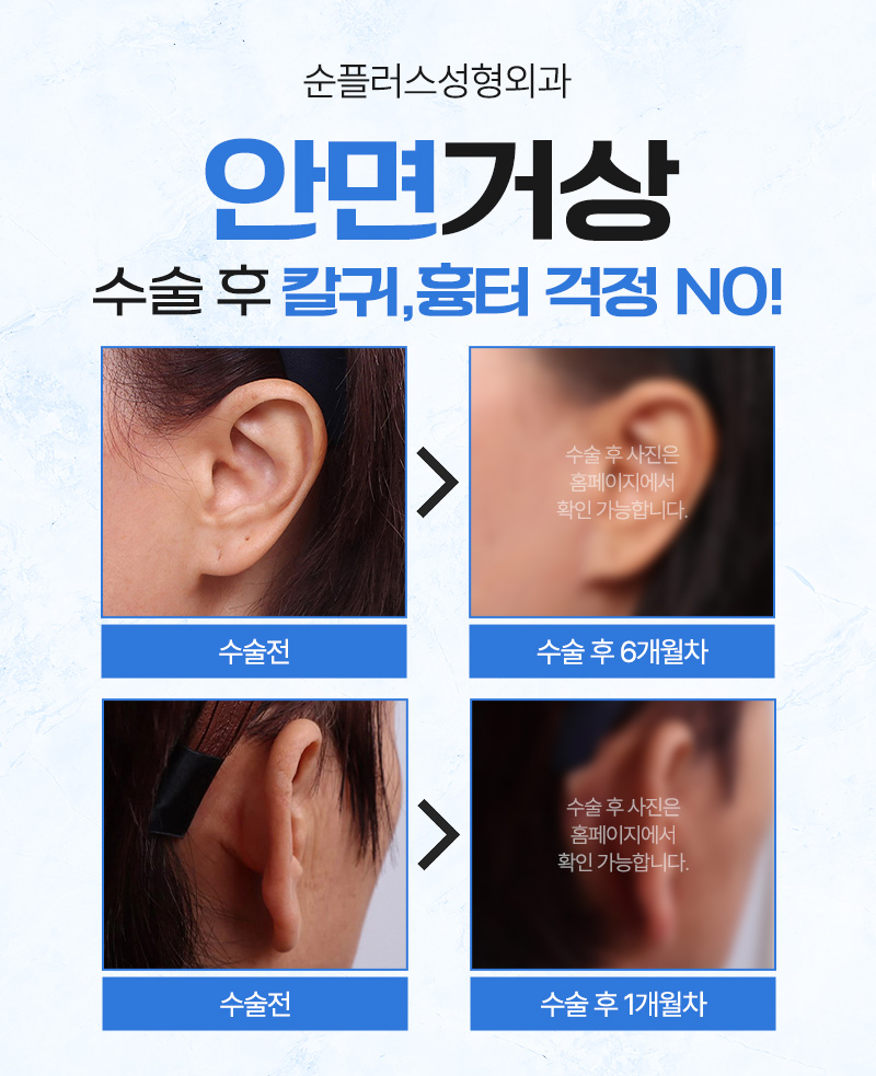 안면거상술 왜 필요한가? 효과, 수술방법, 주의사항까지 관련 이미지 6
