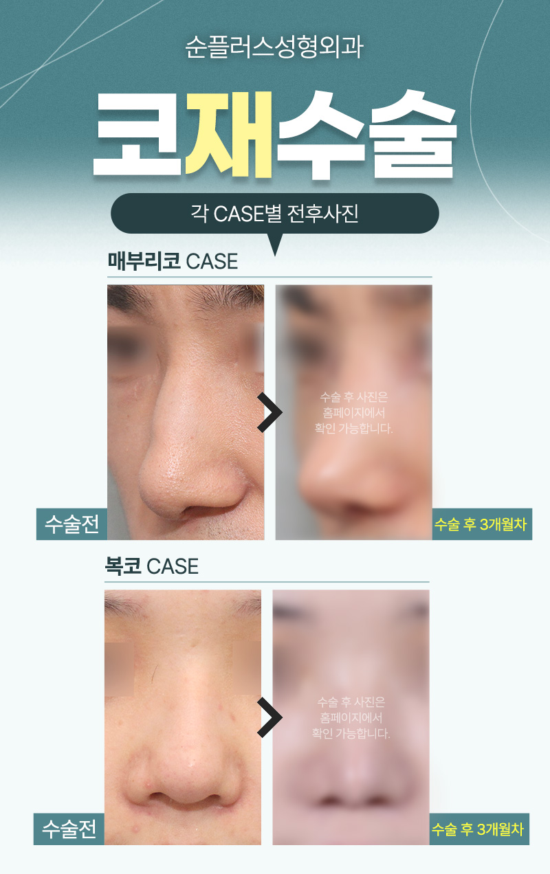 코성형재수술 니즈에 맞춘 플랜으로 관련 이미지 6