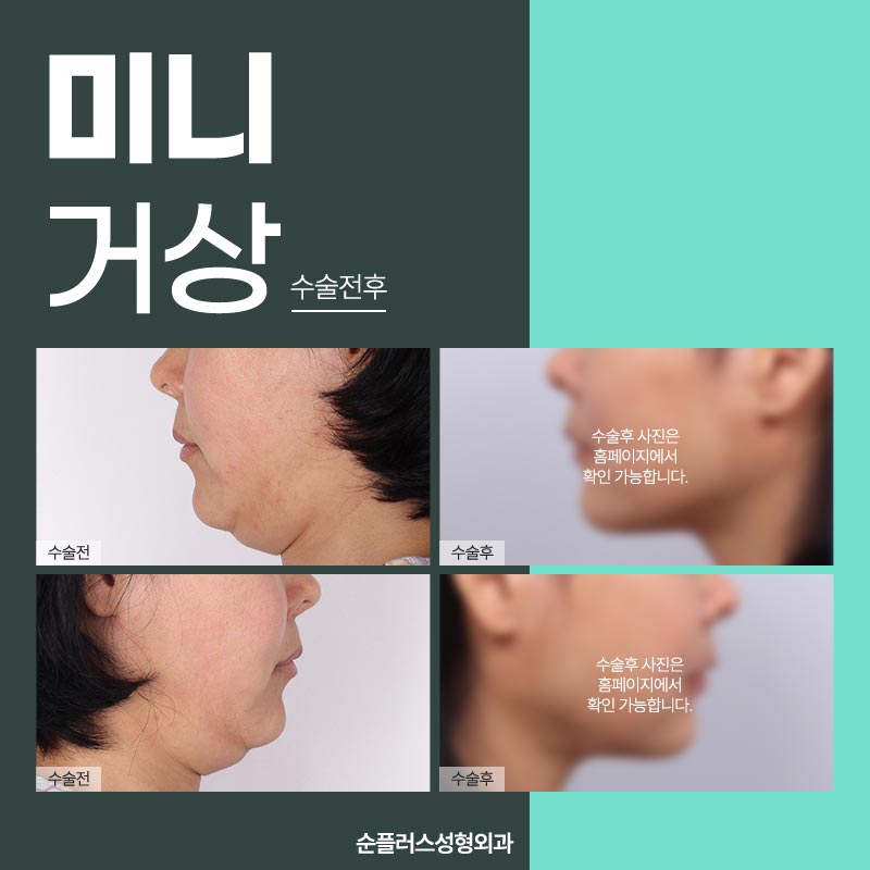 스마스층까지 당겨주는 미니거상술 관련 이미지 5