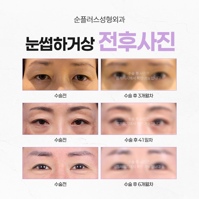 50대 60대 눈썹하거상, 자연스러운 동안 인상의 핵심은 따로 있다. 관련 이미지 5