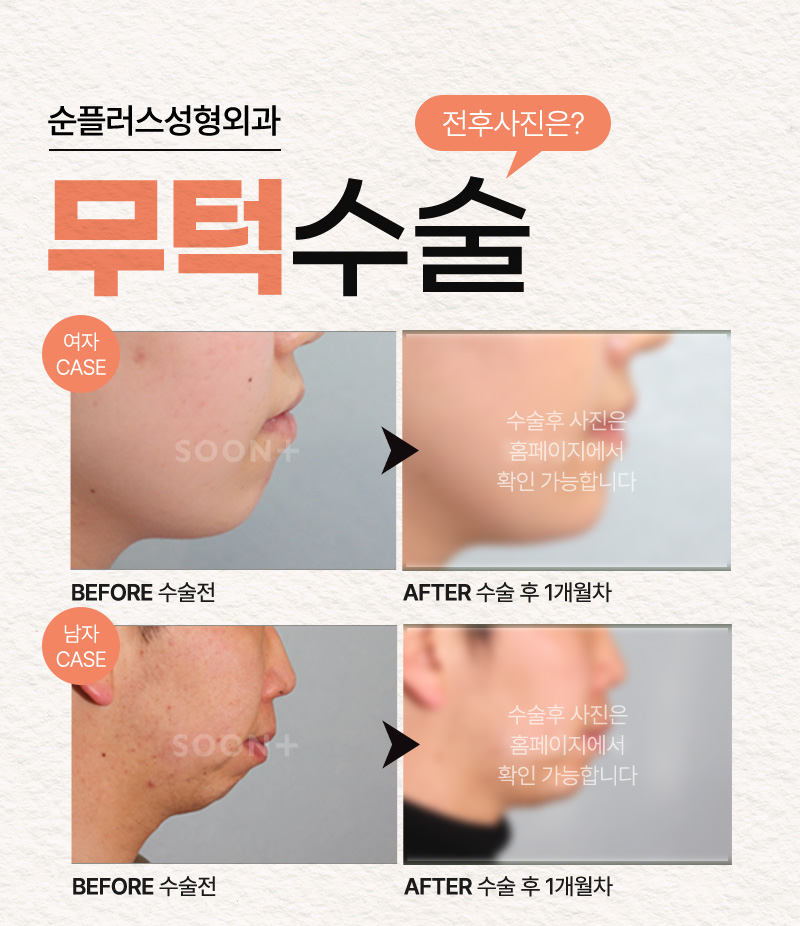 If a Protruding Upper Jaw Because of a Small Chin Tip Is a Concern, Alleviation Through Chin Surgery image 5