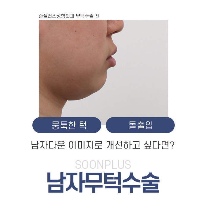 Male Chin-Deficiency Surgery: Even Just the Chin Tip Can Make a Difference image 2