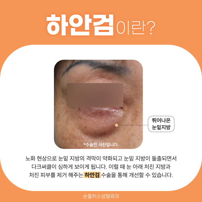 하안검수술잘하는병원 눈밑처짐을 제거해야 관련 이미지 2