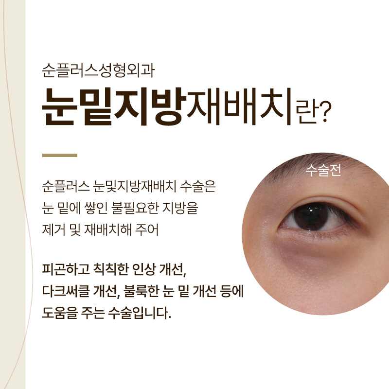다크써클수술 눈밑지방재배치성형외과 선택은? 관련 이미지 2