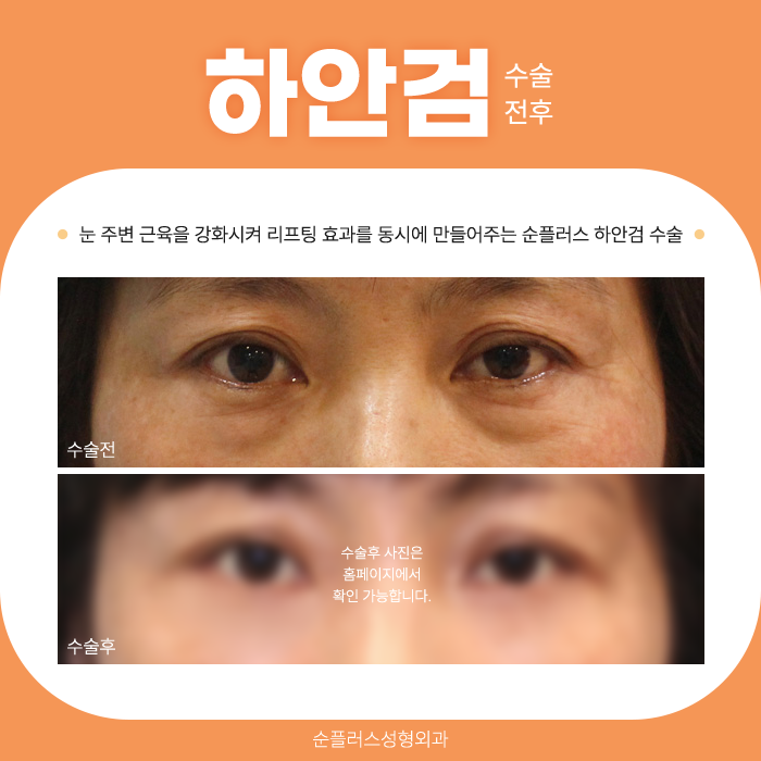 하안검수술잘하는병원 눈밑처짐을 제거해야 관련 이미지 5