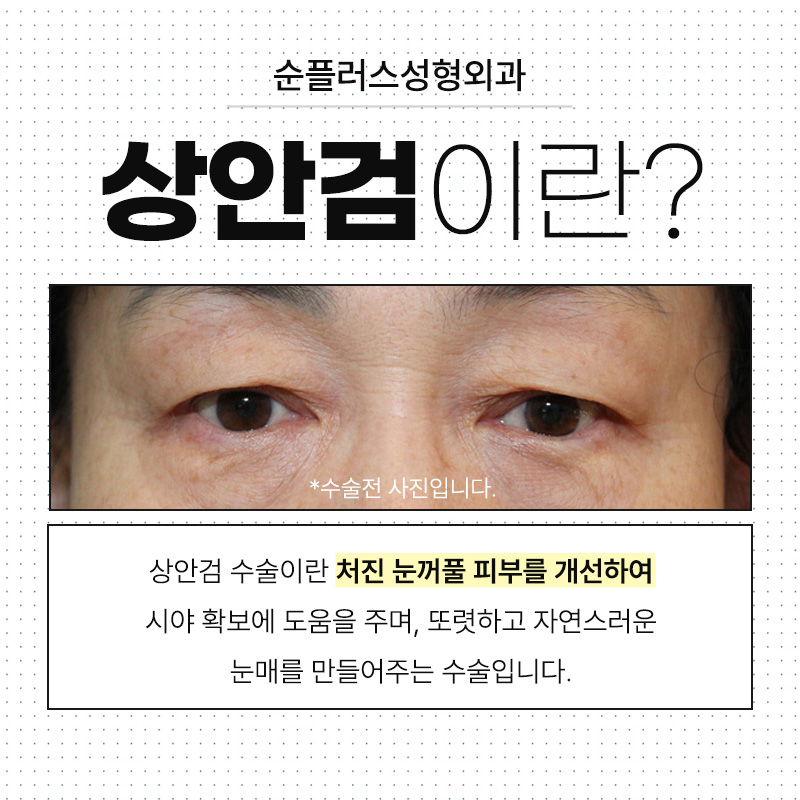 처진눈수술 늘어진 피부 개선으로 선명한 인상과 시야확보까지 관련 이미지 2