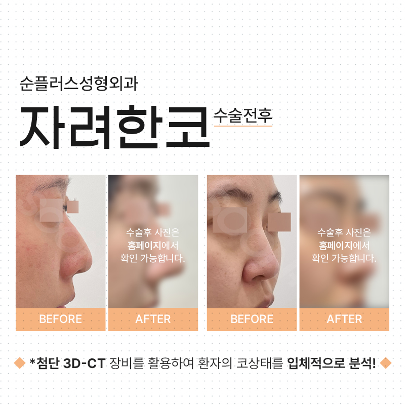 From an Elegant Nose Line to the Bridge and Tip Line You Want_Customized Nose Surgery image 5