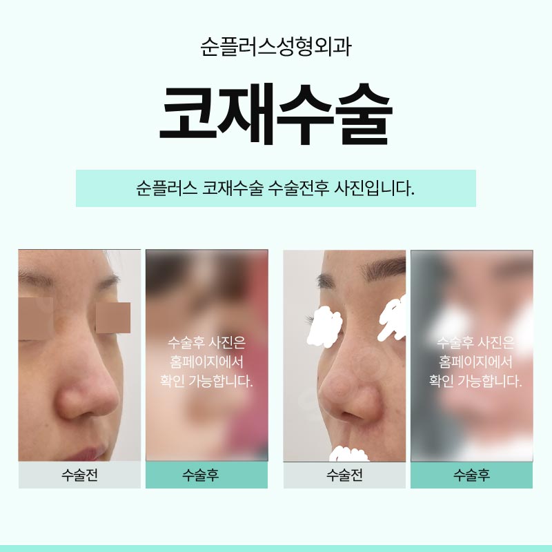 코재수술성형외과 이전에 문제점이 무엇인지 관련 이미지 6