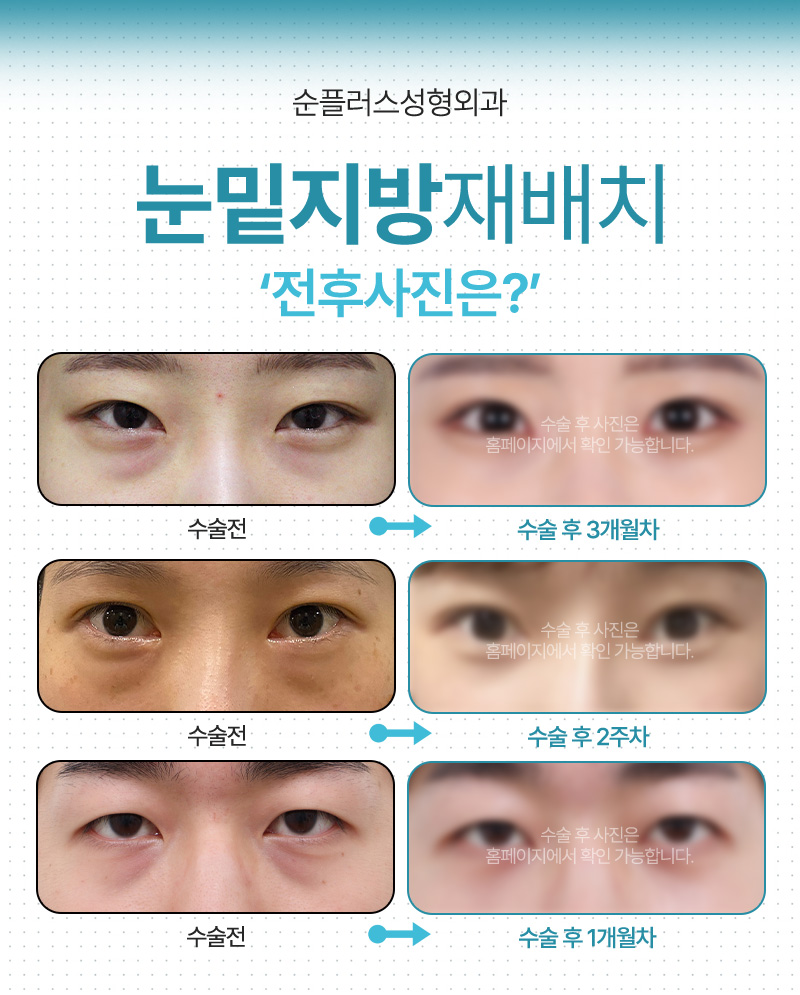 눈밑지방재배치 수술후 차후에도 지방이 돌출되지 않도록 이중고 관련 이미지 6