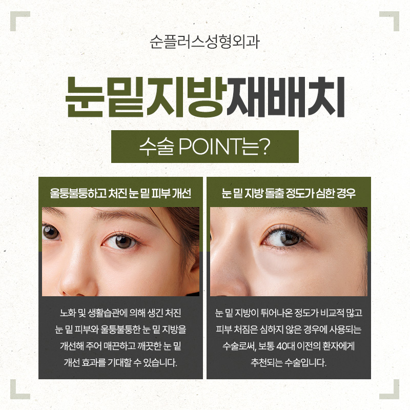 Under-Eye Fat Repositioning Effect - What if Bulging Under-Eye Fat Is Removed? image 3