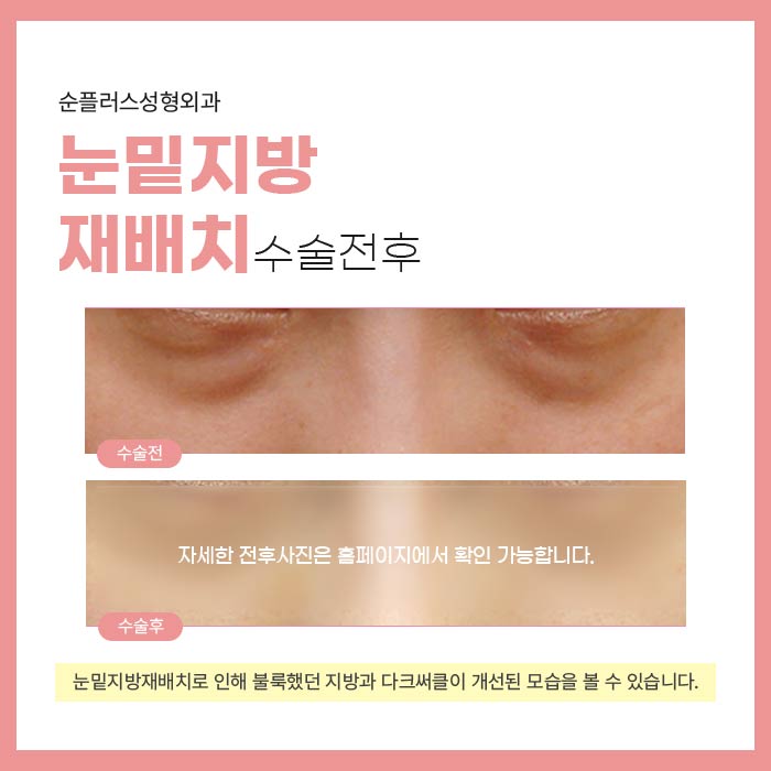 눈밑지방재배치수술 비용과 과정도 꼼꼼하게 관련 이미지 5