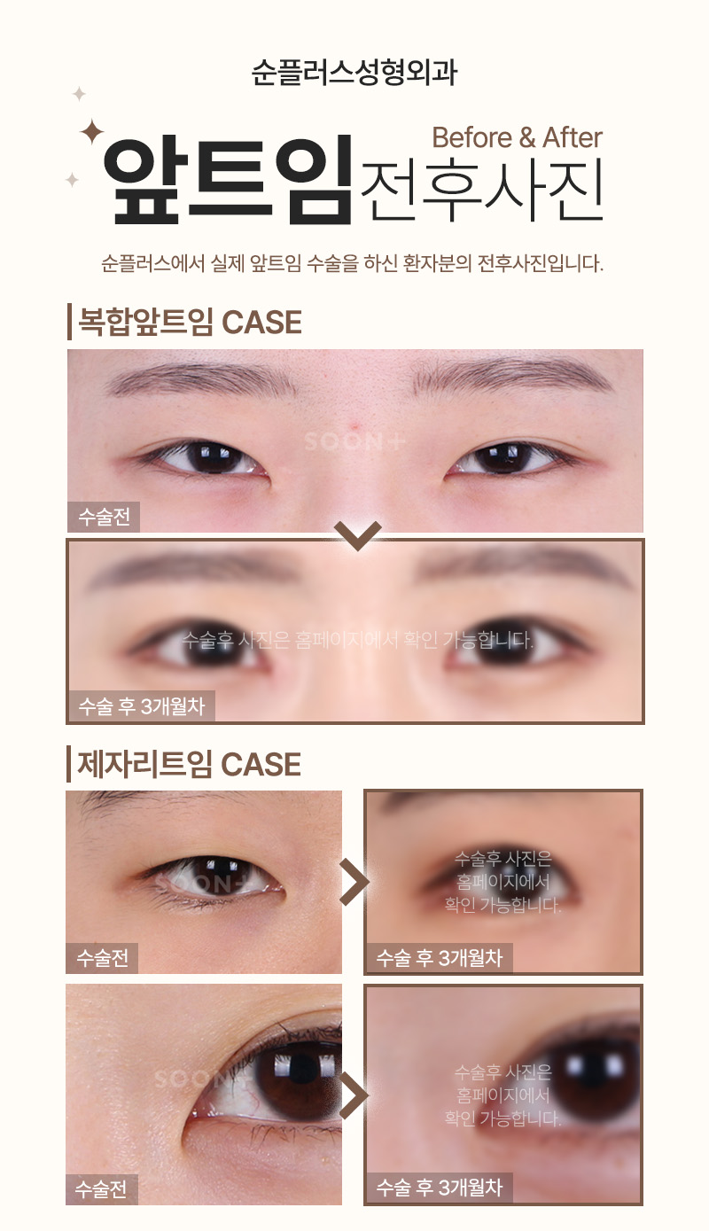 앞트임 통해 몽고주름 개선하고 또렷하게 관련 이미지 6