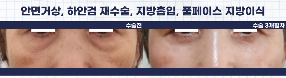 하안검재수술도 원인에 맞는 플랜으로 관련 이미지 4