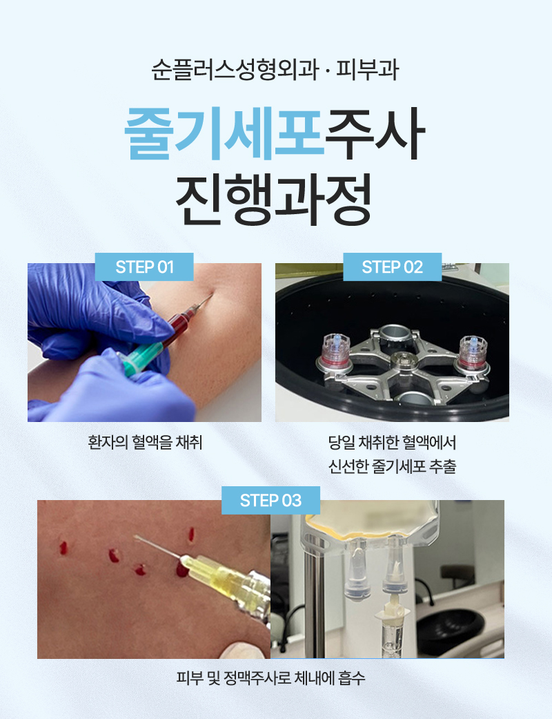 줄기세포 스킨부스터, 피부주사로 손상된 피부를 치유하고 재생시켜 (서울 강남 줄기세포 병원) 관련 이미지 5