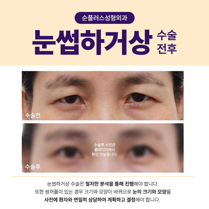 눈꺼풀처짐수술, 눈썹하거상 케이스로는 관련 이미지 6