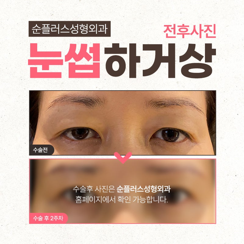 처지는 눈꺼풀 중년눈수술 눈썹하거상 관련 이미지 7