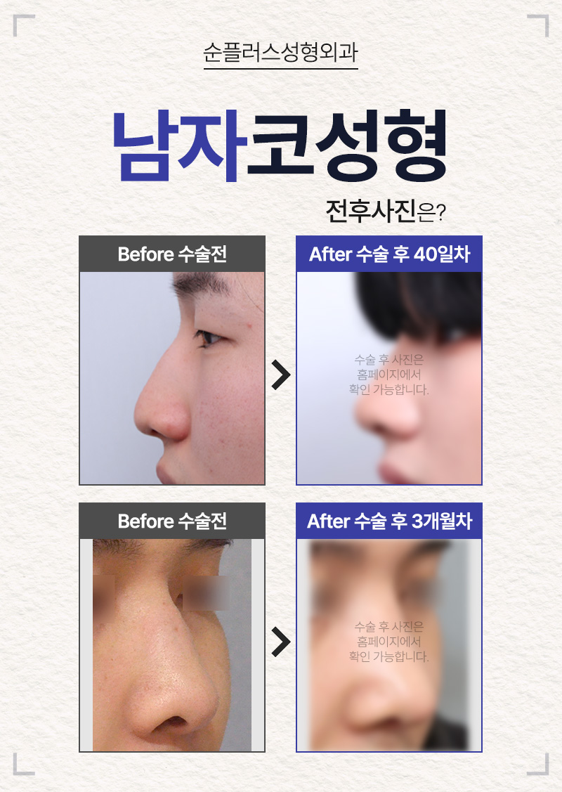 남자코수술 전후 후기 확인해가며 신중한 선택을 관련 이미지 7