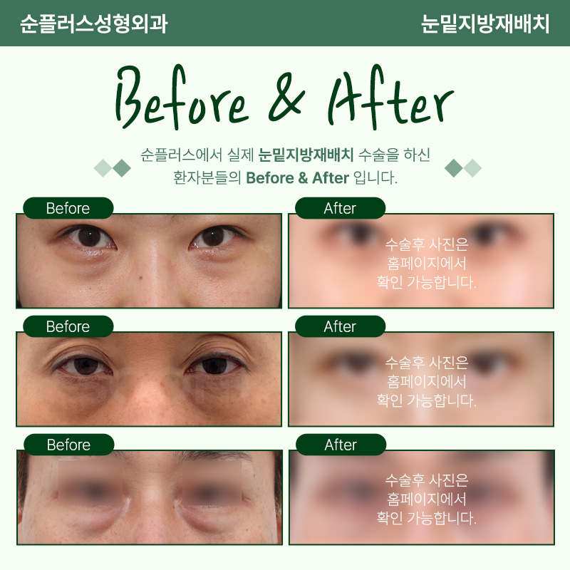Gangnam Under-Eye Fat Repositioning Plastic Surgery Removes Protruding Fat image 4