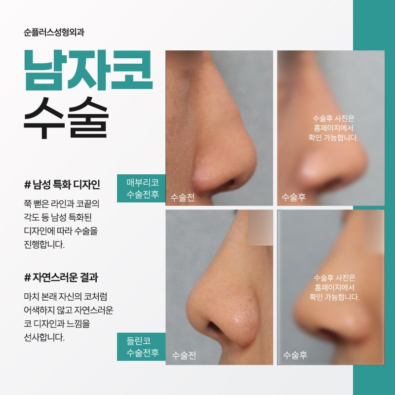 남자코성형가격 면밀하게 따져가며 관련 이미지 4