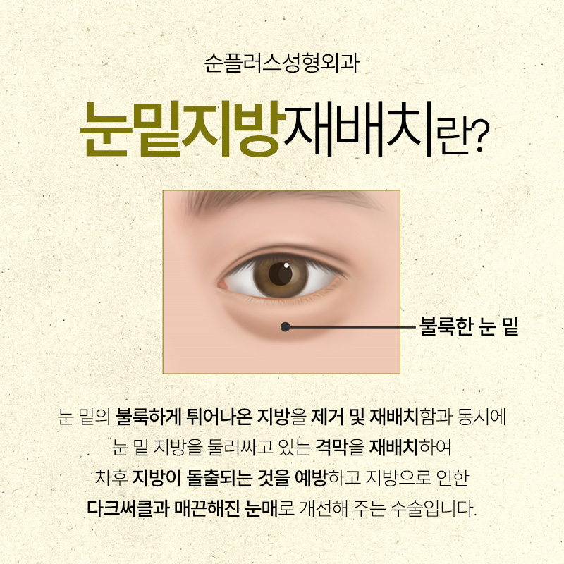 눈밑지방재배치 수술로 칙칙한 다크써클 개선할 수 있나요? 관련 이미지 2