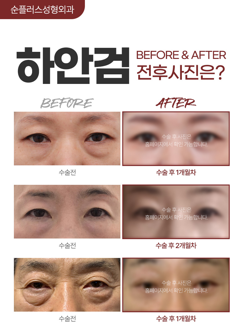 50대 60대 눈밑지방성형은 지방과 피부처짐 동시개선이 필요할수도 [하안검] 관련 이미지 4