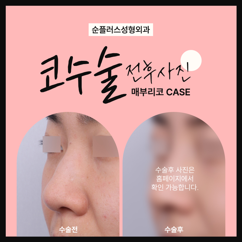 코성형외과유명한곳 균형이 중요하지 관련 이미지 5