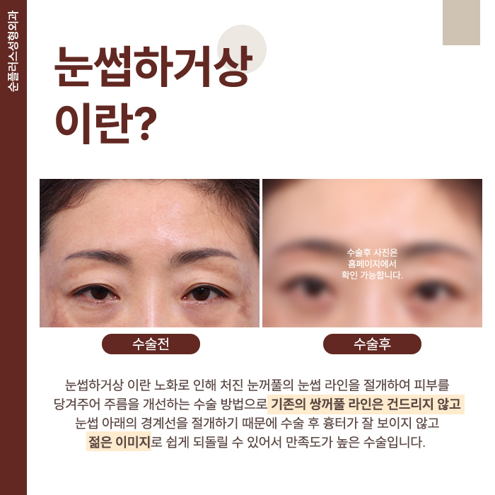 중년 처진 눈꺼풀수술 탄력되찾으며 관련 이미지 2