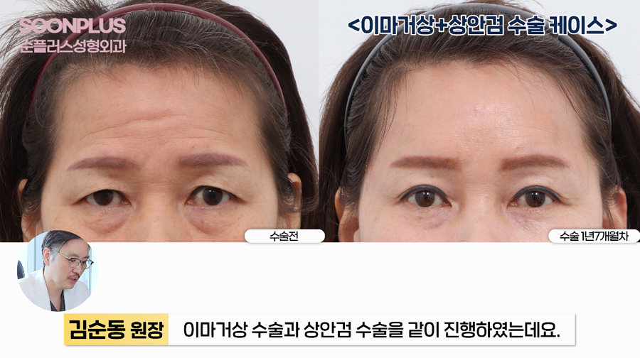 What Surgery Is Performed to Improve Drooping Eyelids and Sagging Eyes, Even by Celebrities? image 9