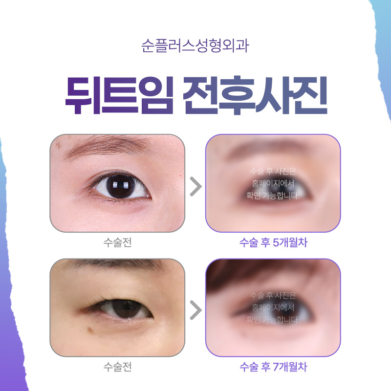 Lateral Canthoplasty (Outer Corner Surgery): Expanding the Horizontal Length While Lowering the Outer Eye Corner for a More Open Look image 5