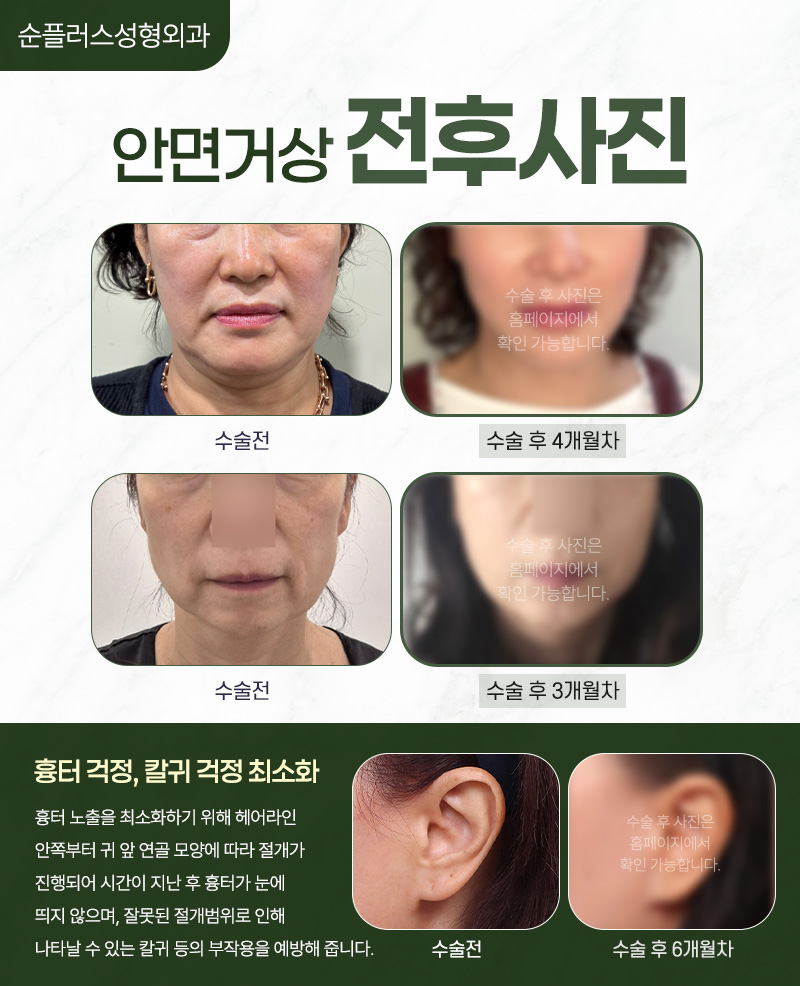 안면거상잘하는병원 신중한 선택이 필요! 관련 이미지 5
