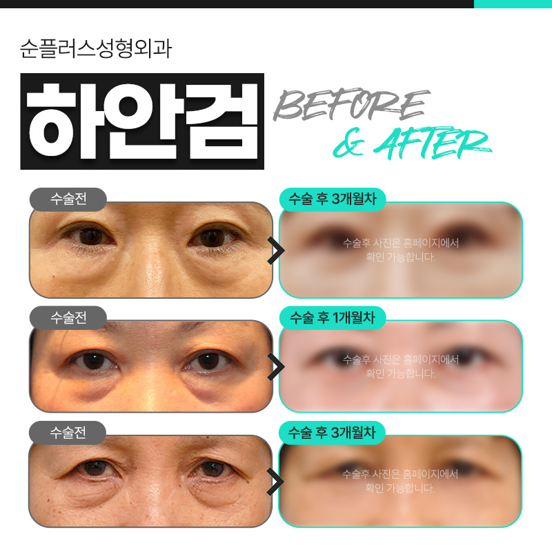 Best Place for Lower Blepharoplasty: More Than Just Fat Removal, Including Sagging Skin image 4