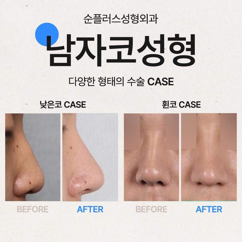 남자코성형잘하는곳 케이스별로 맞춘 관련 이미지 5