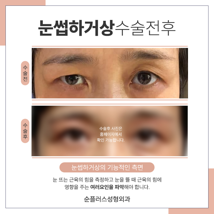 For Eye Shape Changes Through Midlife Eyelid Drooping Surgery image 6