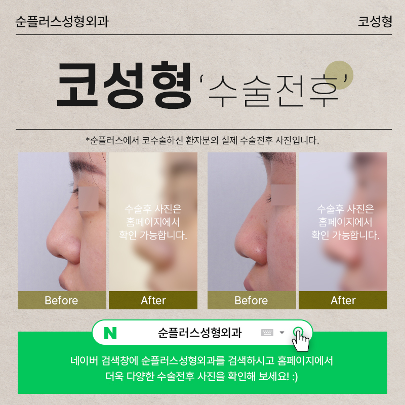 Natural Rhinoplasty in Harmony with Your Surrounding Facial Features image 6