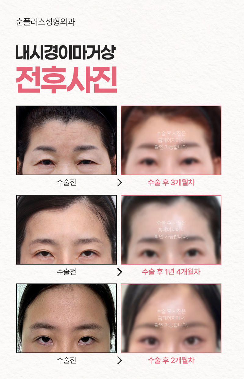 If Endoscopic Forehead Lift Precautions Are Followed Well image 5